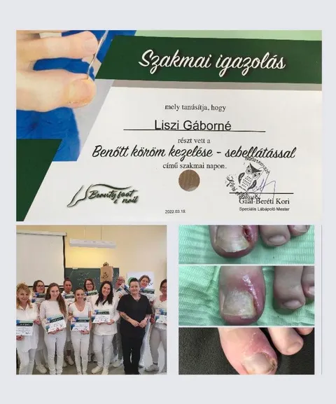 Szakmai igazolás: Benőtt köröm kezelése sebellátással